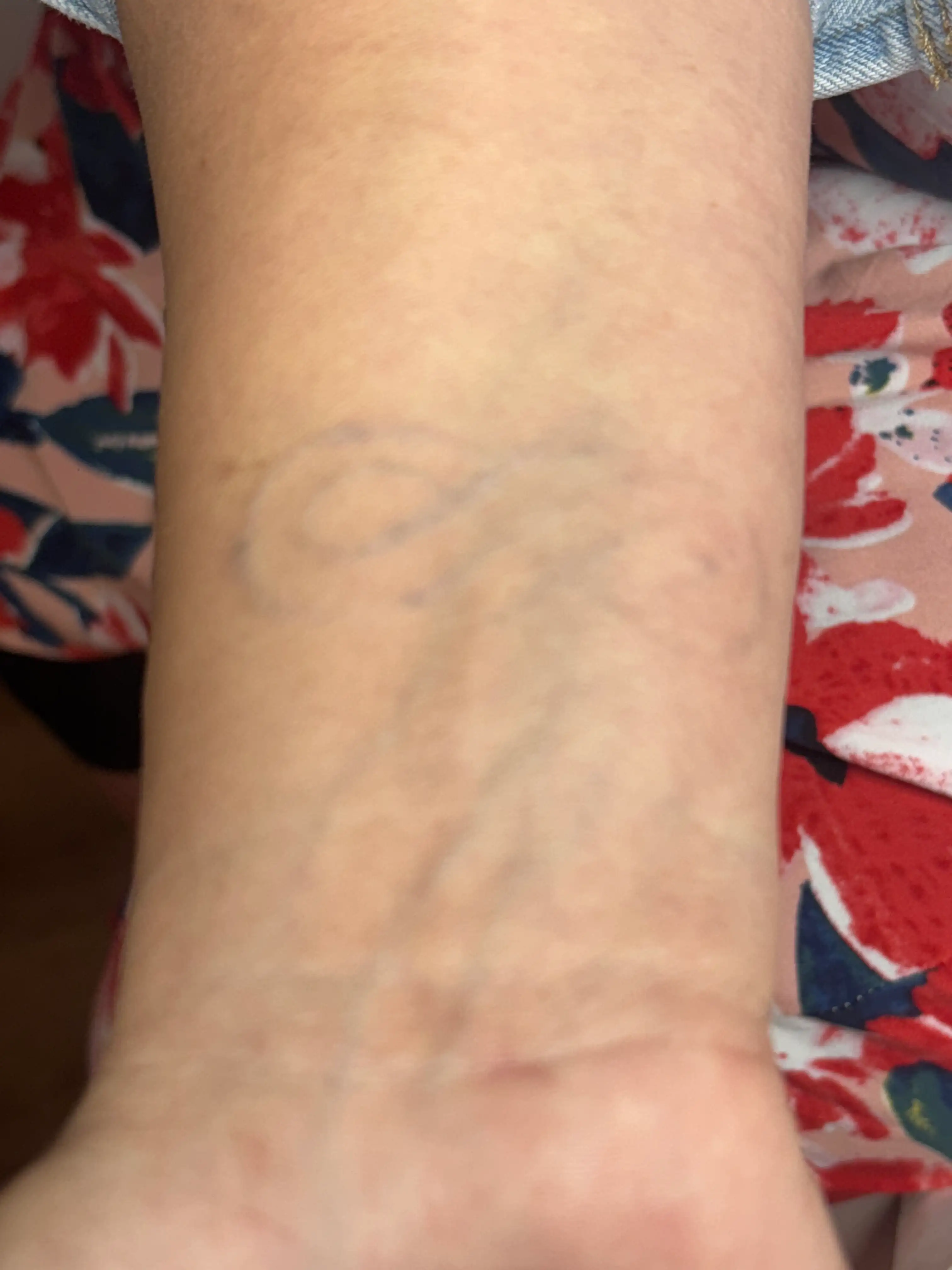 Détatouage à Caen : ce qu’il faut savoir avant de se faire tatouer